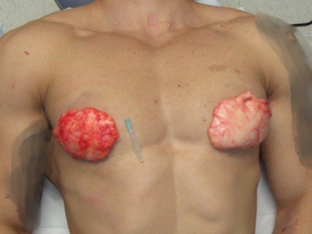 gynecomastia steroids symptoms