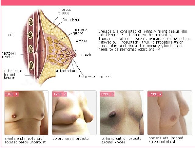 Types of male breast surgery