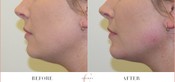Chin Enhancement Before & After