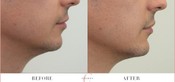 Chin Enhancement Before & After