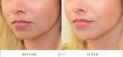 Chin Enhancement Before & After
