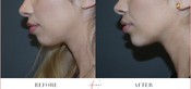 Chin Enhancement Before & After