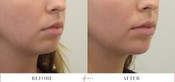 Chin Enhancement Before & After