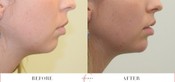 Chin Enhancement Before & After