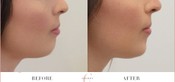 Chin Enhancement Before & After