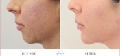 Chin Enhancement Before & After