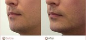 Chin Enhancement Before & After