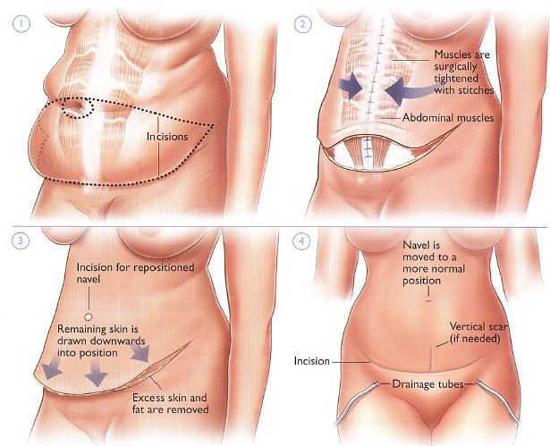 What Is The Effect of a Plus Size Tummy Tuck And a BBL?