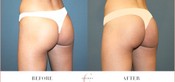 Non-Invasive Butt Lift Before & After