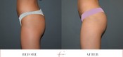 Non-Invasive Butt Lift Before & After