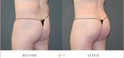 Male Buttock Enhancement Before & After