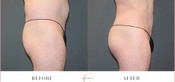 Male Buttock Enhancement Before & After