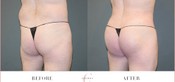 Male Buttock Enhancement Before & After