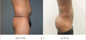 Male Buttock Enhancement Before & After