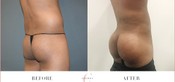 Male Buttock Enhancement Before & After