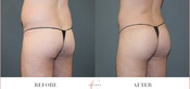 Male Buttock Enhancement Before & After