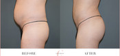 Male Buttock Enhancement Before & After
