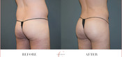 Male Buttock Enhancement Before & After
