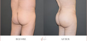 Male Buttock Enhancement Before & After