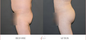 Male Buttock Enhancement Before & After