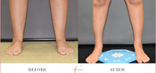 Cankle Surgery Before & After