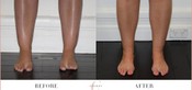 Cankle Surgery Before & After