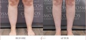 Cankle Surgery Before & After