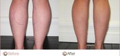 Cankle Surgery Before & After