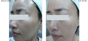 Non-Surgical Eyelid Lift Before & After