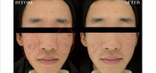 Non-Surgical Eyelid Lift Before & After