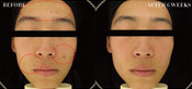 Non-Surgical Eyelid Lift Before & After