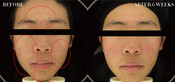 Non-Surgical Eyelid Lift Before & After
