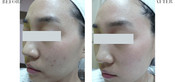 Non-Surgical Eyelid Lift Before & After