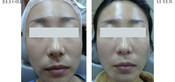 Non-Surgical Eyelid Lift Before & After
