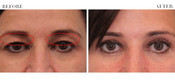 Non-Surgical Eyelid Lift Before & After