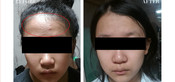 Non-Surgical Eyelid Lift Before & After
