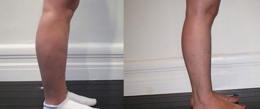Knees/Calves/Ankles Liposuction