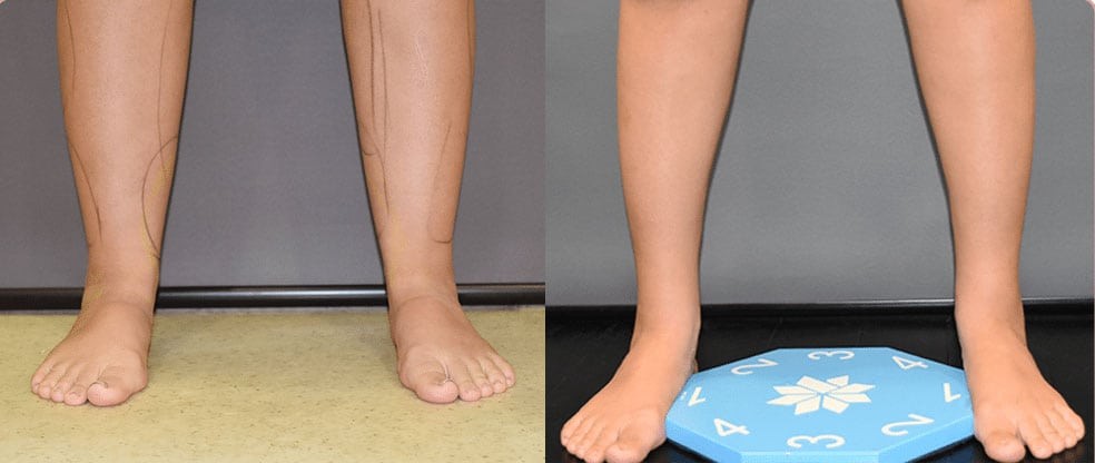 Knees/Calves/Ankles Liposuction
