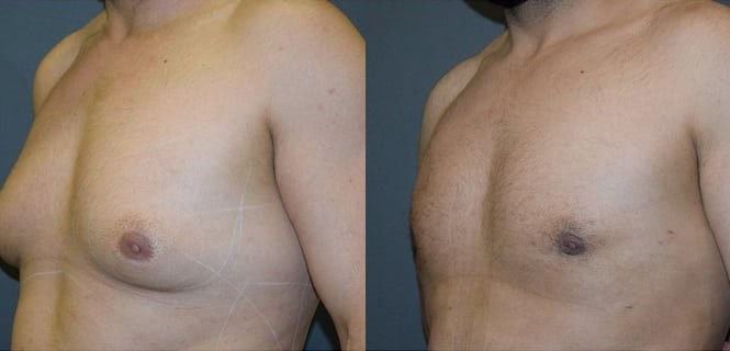 Gynaecomastia (Male Chest) Before & After