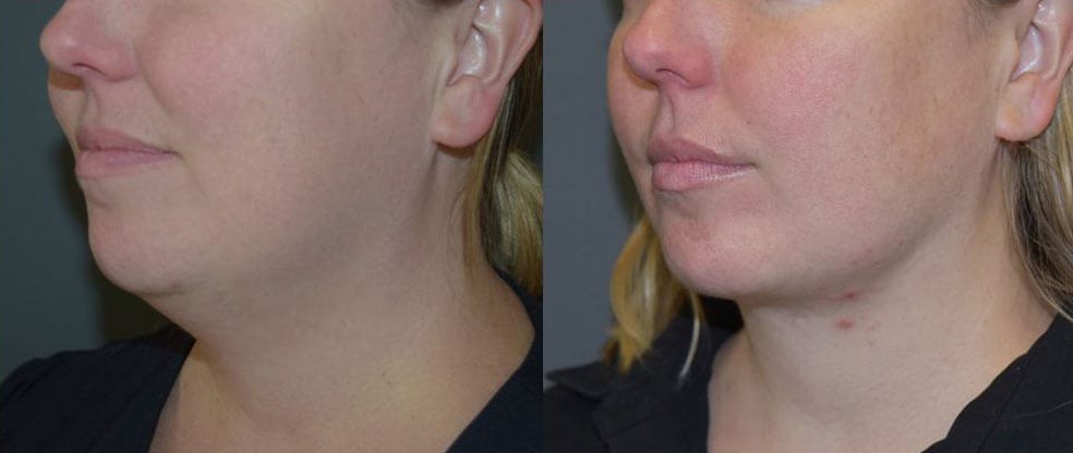 Neck Liposuction Before & After