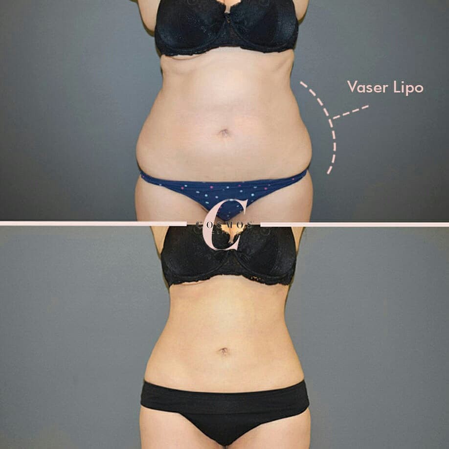 How Vaser Liposuction Minimizes Bruising - Dr. Laguna