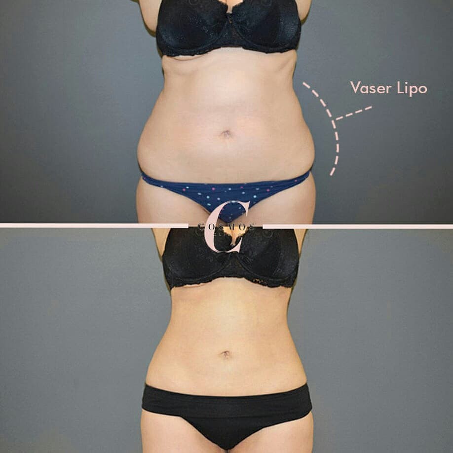 What To Wear After a Liposuction