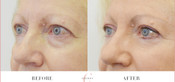 Non-Surgical Eyelid Lift Before & After
