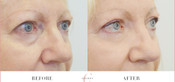 Non-Surgical Eyelid Lift Before & After