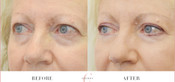 Non-Surgical Eyelid Lift Before & After