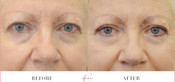 Non-Surgical Eyelid Lift Before & After
