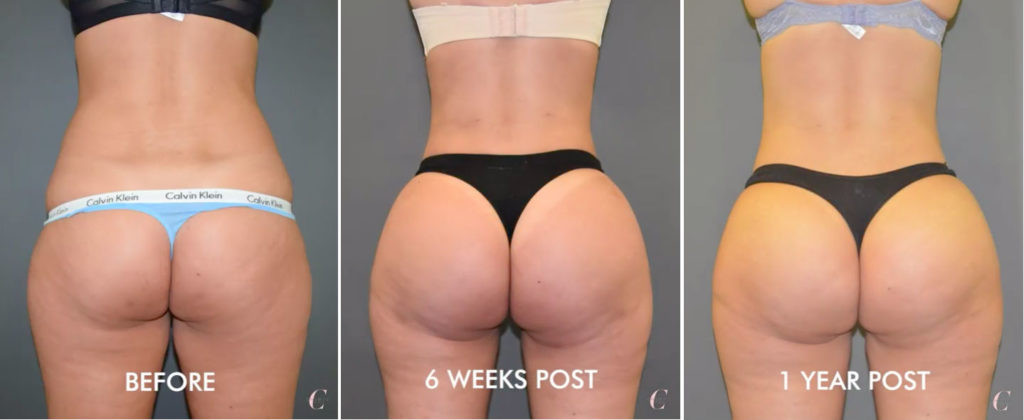 Before, 6 weeks and 1 year after Brazilian Butt Lift augmentation