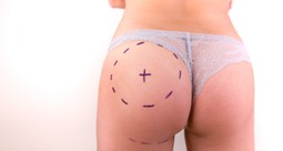 Fat Survival After a Brazilian Butt Lift