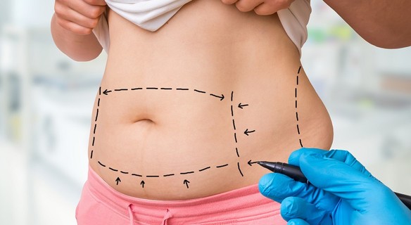 Stomach Liposuction - Discover Our Unique Approach