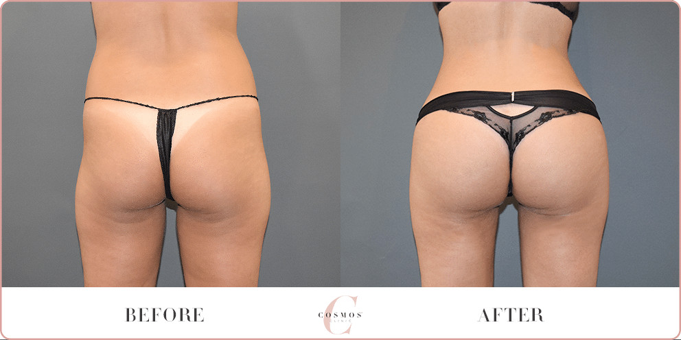 Brazilian Butt Lift: How Big Should I Go? - Cosmos Clinic